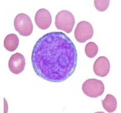 An immature lymphocyte called a lymphoblast (blue/purple cell) surrounded by several mature red blood cells. Lymphoblasts in circulation indicate the bone marrow is diseased.