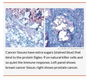 Cancer tissues have extra sugars (stained blue) that bind to the protein Siglec-9 on natural killer cells and so quiet the immune response. Left panel shows breast cancer tissue; right shows prostate cancer.