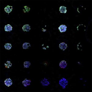 A chemical array screens for malignant melanoma cell types. Each dot contains a different combination of protein segments derived from the tumor environment. Credit: Kristopher Kilian 