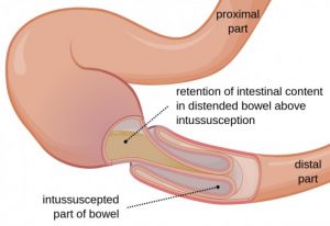 bowel