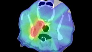 A scan showing targeted radiation to treat a brain tumor. Red/orange shows a high dose.