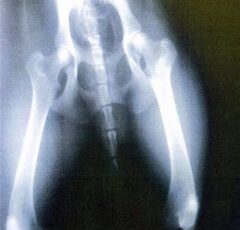 Bone tumor diagnosis devastating but common